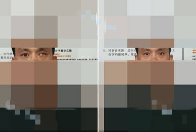 蓝平（化名）意外受伤右眼粉碎